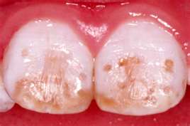 Fluorosis
